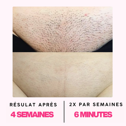 Épilateur à lumière pulsée Paris