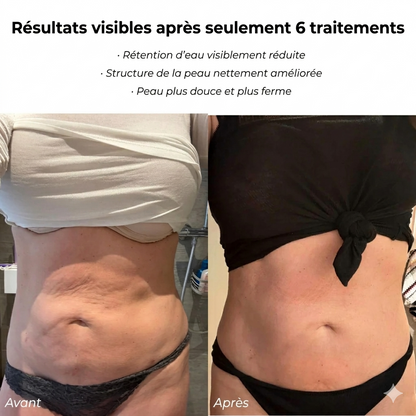 Lyméra™ Sculpt