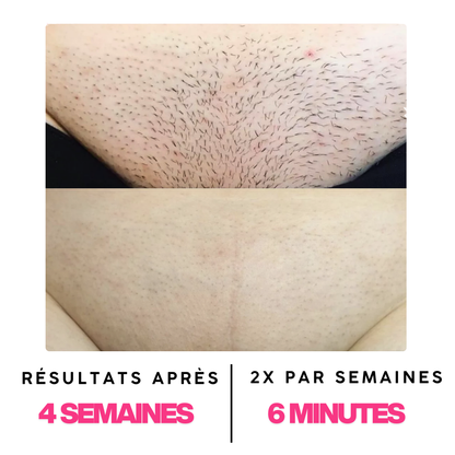 Épilateur à lumière pulsée Paris